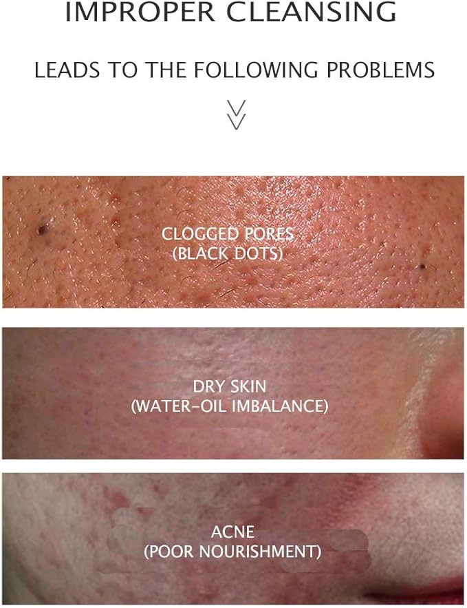 Amino Acid Cleansing Facial Anti-Acne Essence Moisturizing Removed Mites Natural Ingredients Water-Oil Balance